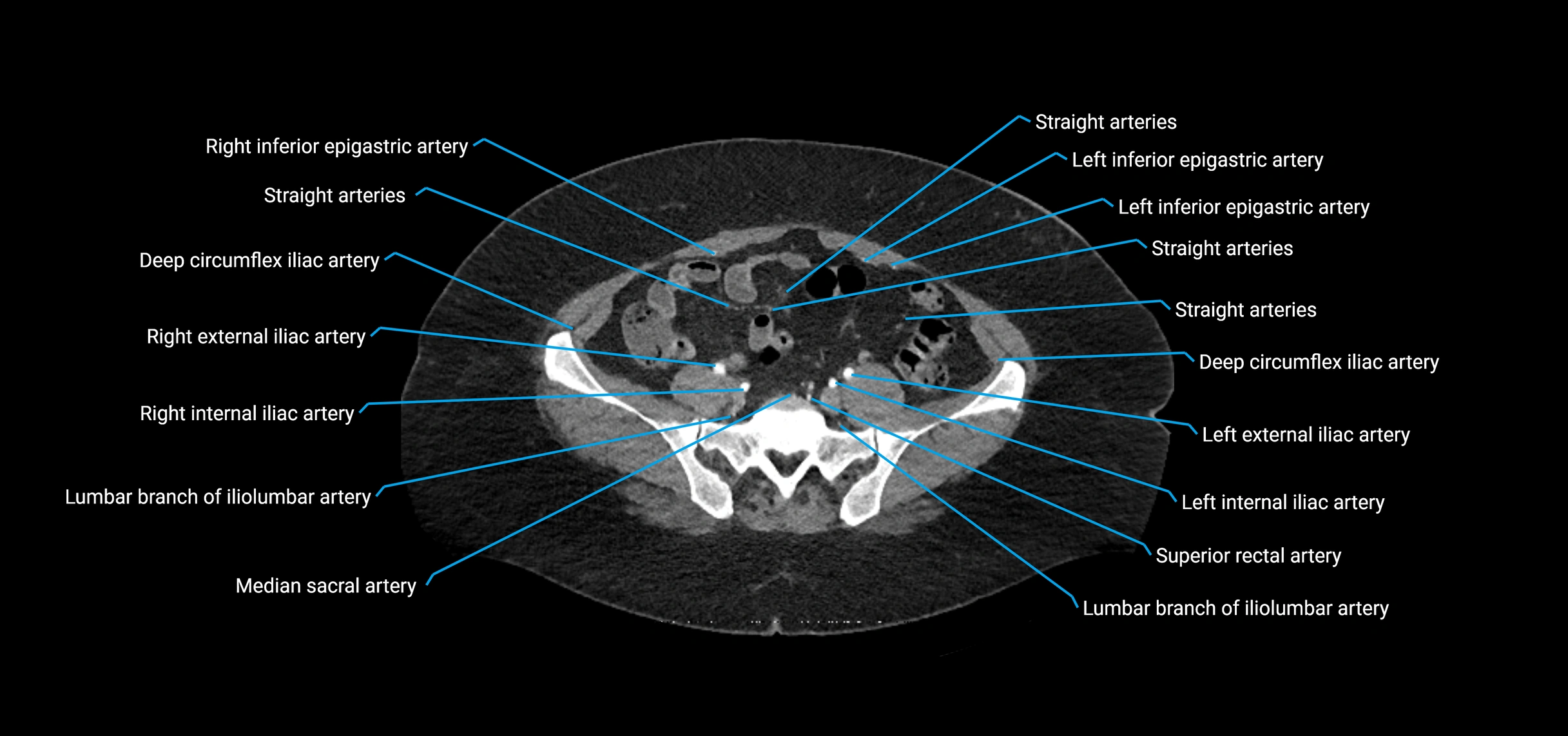 CTA abdomen axial cross sectional anatomy labelled image_182 (2).webp